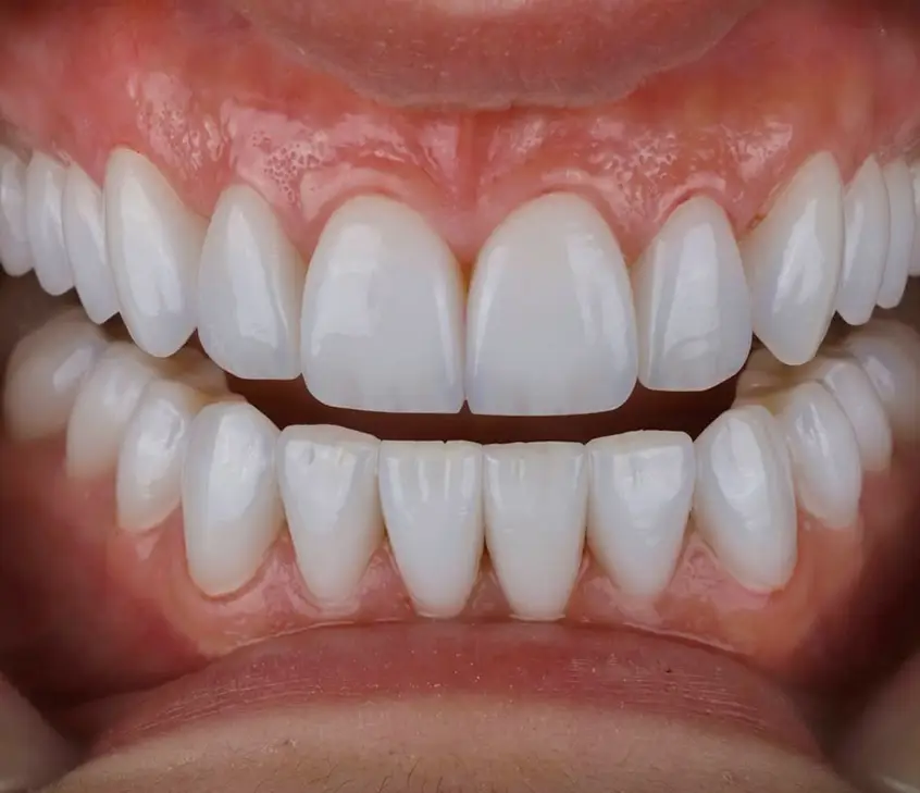 Teeth Whitening